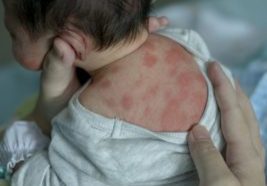 Erythema-Toxicum-In-Newborns-Causes-Symptoms-And-Treatment-1-910x1024.jpg