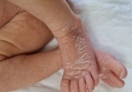 Skin-Peeling-In-Newborns.jpg